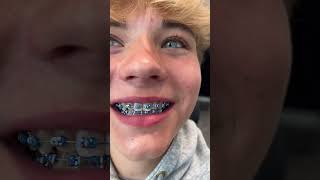 Download lagu Braces Color Options 🔥 3 Cool Styles... mp3