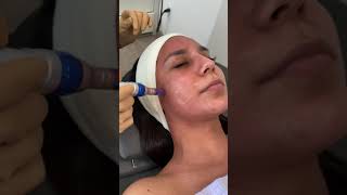 Microneedling 😮😬💉 | Evoclinic