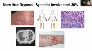 What is Sjogren’s disease and how is it managed?