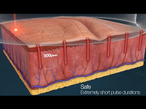 AcuPulse C02 Fractional Laser Resurfacing -  Q&A