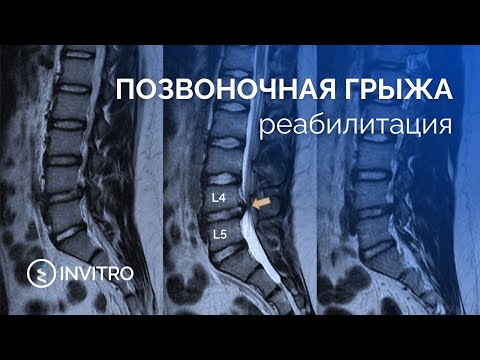 Terapia herniei de disc intervertebral