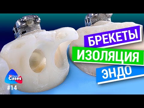 Брекеты, изоляция, эндо | Дентал кейсы от BG #14