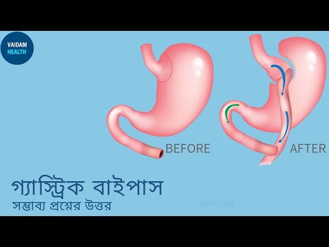 গ্যাস্ট্রিক বাইপাস- প্রায়শই জিজ্ঞাসিত প্রশ্ন