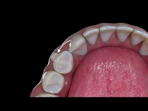 Shiny Aligner