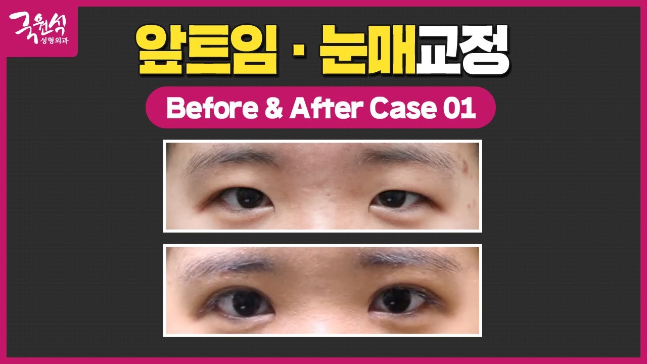 앞트임과 눈매교정 쌍꺼풀 사례 썸네일