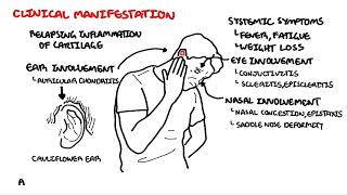 Relapsing Polychondritis