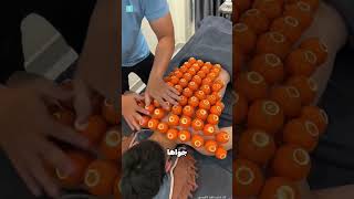 العلاج عن طريق الحجامه shorts