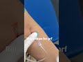Blood Draw For Prd And Bone Graft Dentist Blooddraw Dentalimplant Klinikadentaretirane