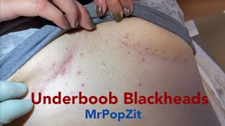 Underboob (infra-mammary) blackhead extractions! Clearing the pores in a common inflamed area.