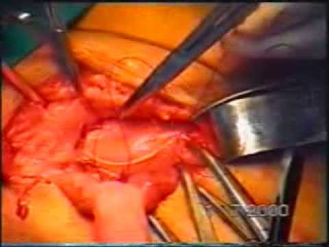 No mesh direct inguinal groin hernia repair surgery-Dr. Desarda Repair