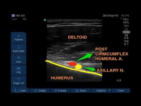 Shoulder Block: Part 3 of 3