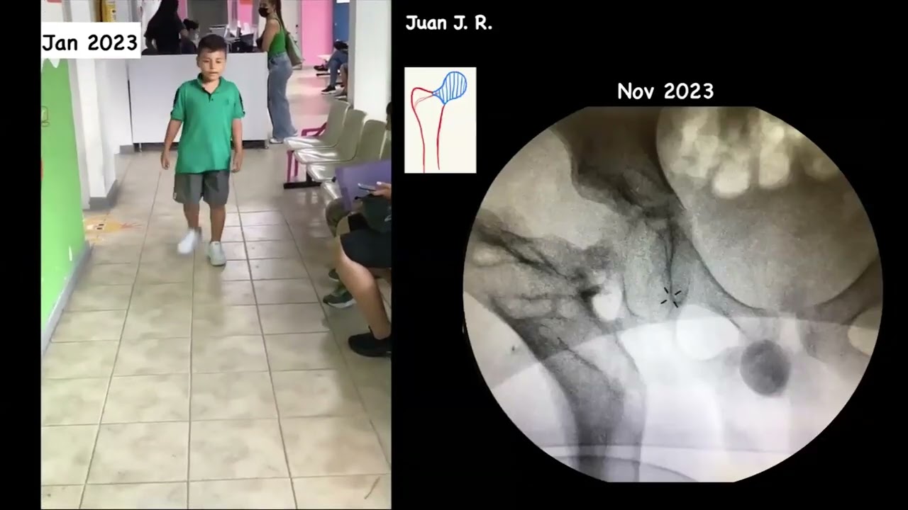 20: External Fixation in Children in a Resource Limited Environment | Miguel Galbán