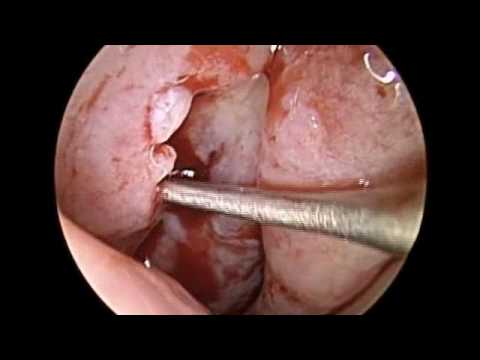 Endoscopic Drainage of Hypoplastic Maxillary Sinus