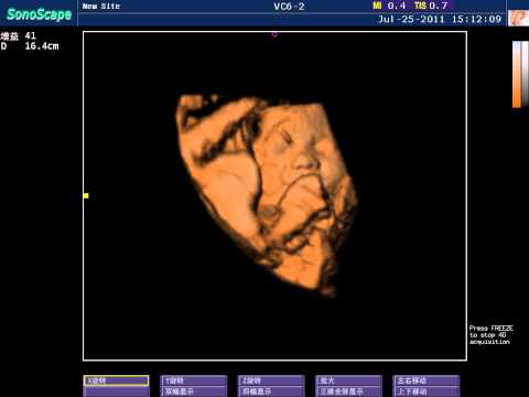 Color Doppler Ultrasound Sonoscape S8 | Demo of 4D Function