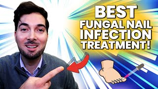 How To Get Rid Of A Fungal Nail Best Treatment