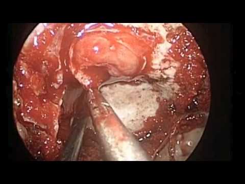 Transsphenoideal Removal of Pituitary Tumor