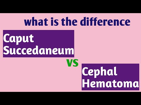 Caput succedaneum vs Cephalhematoma | Pediatrics (english & हिंदी)