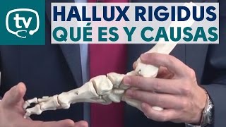 Hallux rigidus, ¿qué es ¿cuáles son sus causas y diagnóstico
