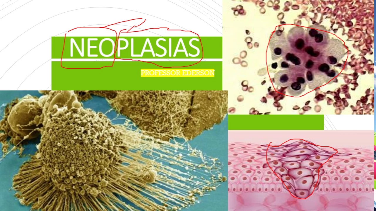Patologia Geral - Neoplasias