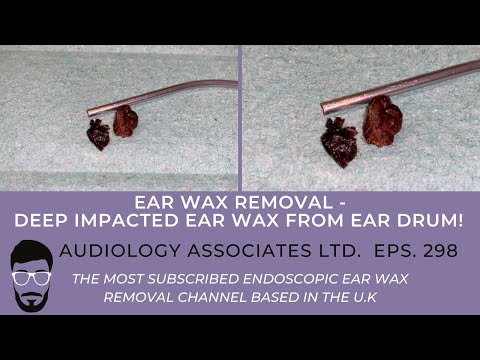 DEEP IMPACTED EAR WAX REMOVAL FROM EARDRUM - EP 298
