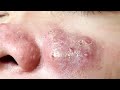 Blackheads & Milia, Big cystic acne blackheads extraction whiteheads Removal Pimple Popping  7