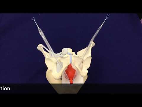 InGyne S istructions for removall the sheath   new version 2018                     cod  IGSD1250EL