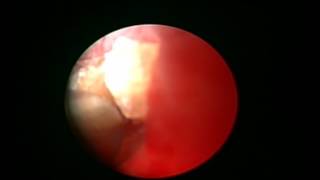 Διαδερμική νεφρολιθοτριψία