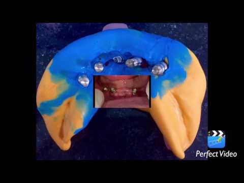 implantes dentales Dra Nayhara Figueredo