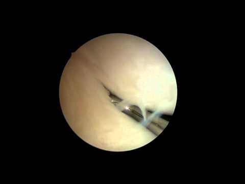 Schmerzen in der frühen Schwangerschaft Behandlungsspalt Sprunggelenkbänder Video