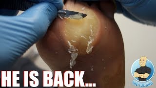WANNA PLAY A GAME?! WATCH &amp; WIN TOEBRO TOOLS!!! ***EXTREME THICK CALLOUS REMOVAL***