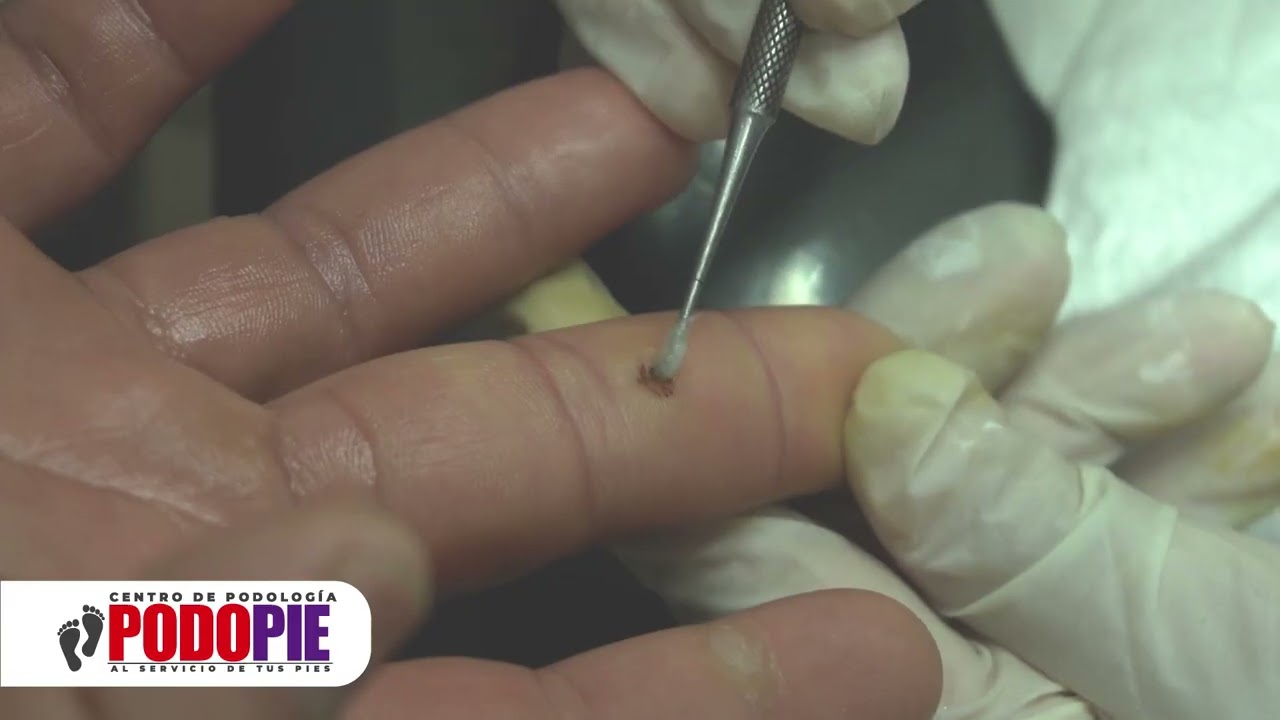 ELIMINACIÓN VPH  MANO