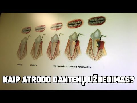 riebalų deginimo kišenė svorio netekimas podcast iTunes