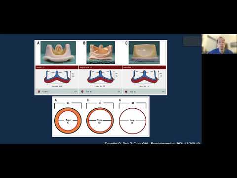 2022 CCC: Valve in Valve TAVR