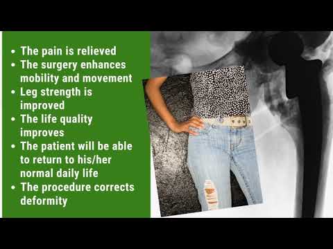 Best Effective Package for Hip Replacement in Cabo San Lucas, Mexico