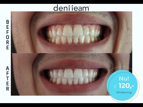 Druif Inferieur controleren Tanden laten bleken? Tandcentrum Dentteam Brunssum
