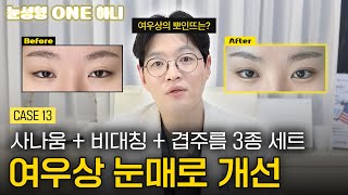 사나운 눈매를 어떻게 여우상으로?🤔  | 눈성형 ONE 하니?