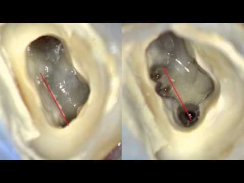 7 Achieving patency and avoiding blockages | Dentsply Sirona