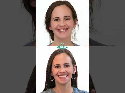 Logo of Essential Breakdown of the All-on-X Dental Implants Procedure in Los Algodones, Mexico