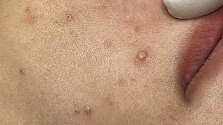 Relaxing Acne Cleansing with LinhMyDang P2 #583