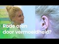 Worden je oren rood als je moe bent? | NOJ
