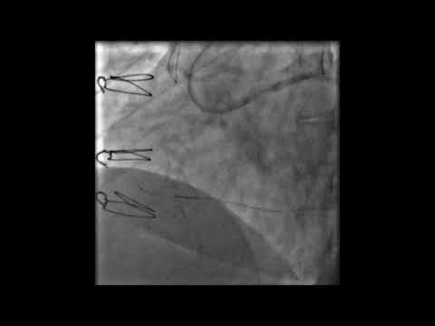 Retrograde CTO PCI through an epicardial channel