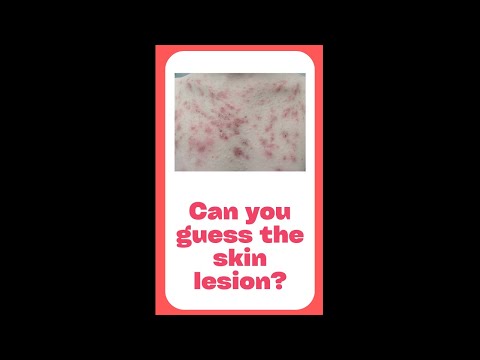 Guess the Lesion | Dermatology Series Part 1 #shorts