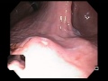Type II Peptic Ulcer