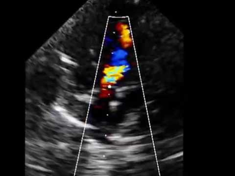 Aortic valve leaking after percutaneus balloon aortic valve dilatation