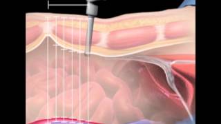 Surgical anatomy of supraumbilical port placement Implications robotic advanced laparoscopic surgery