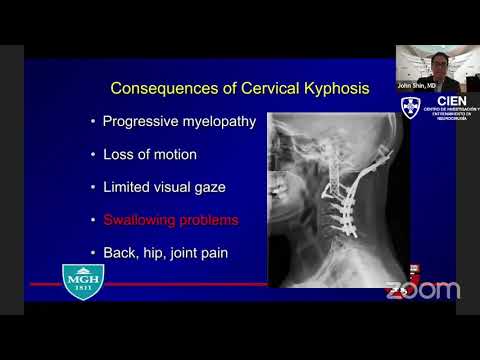 20. Cervical Spinal Deformity by Dr. John Shin