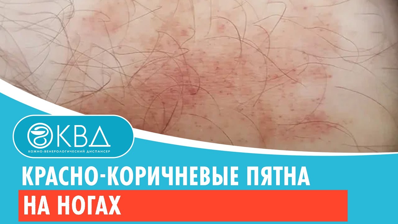 🦵🦵 Красно-коричневые пятна на ногах. Клинический случай №416