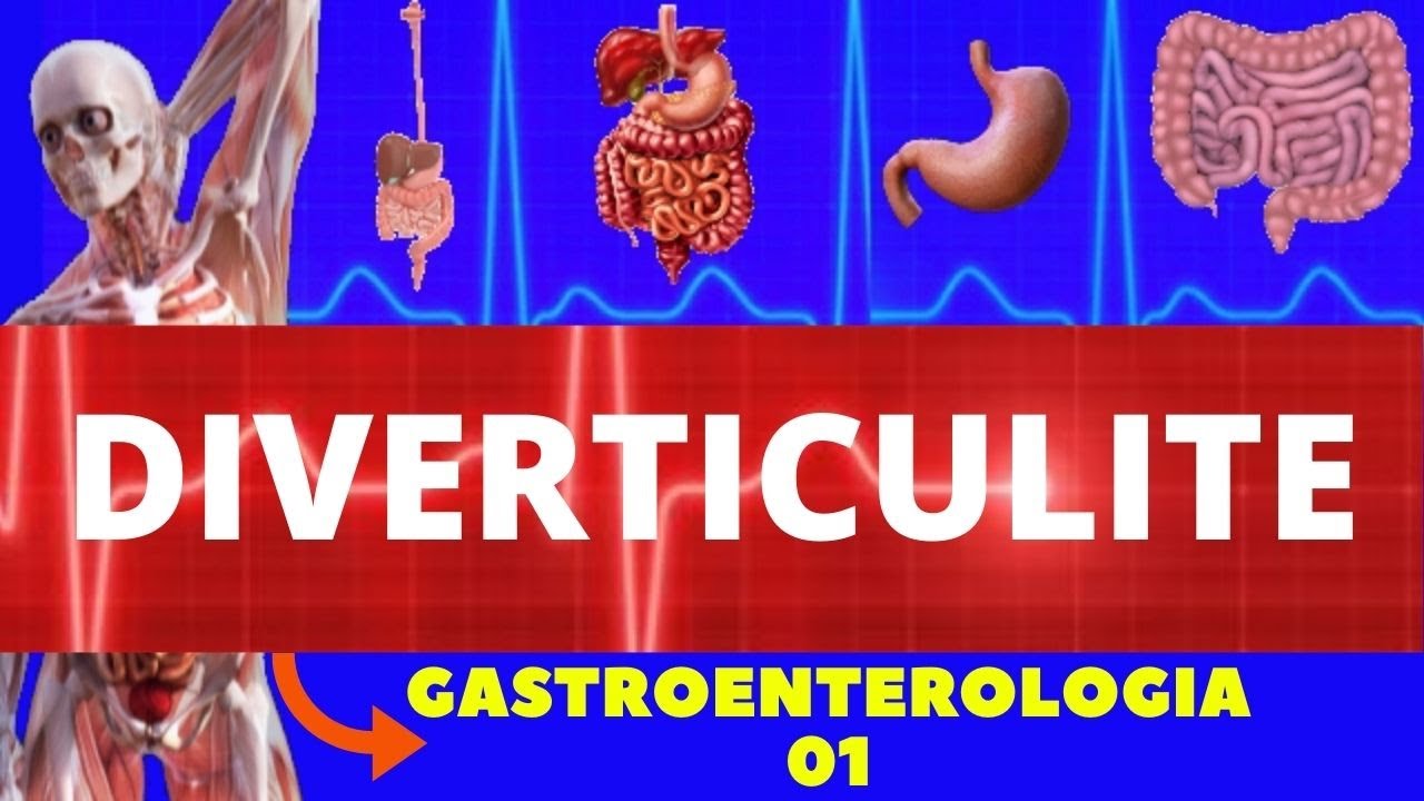 DIVERTICULITE E DOENÇA DIVERTICULAR (CAUSAS, SINTOMAS, DIAGNÓSTICO E TRATAMENTO)