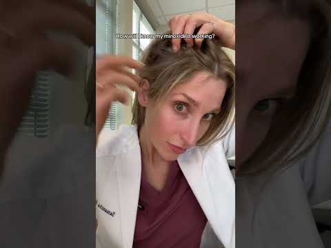 Minwin-F Finasteride And Minoxidil Tablets (5 mg, Pack of 100)