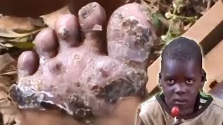 Judith (4 year old) of Kamuli - Treatment for Chigoe Fleas of the Feet